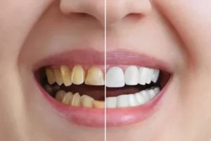 microhybrid cosmedent